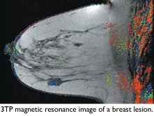 Breast MRI