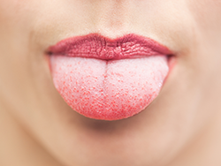 Geographic Tongue