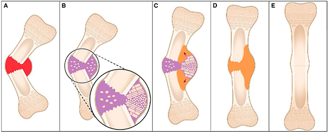 Bone Fracture Diagram