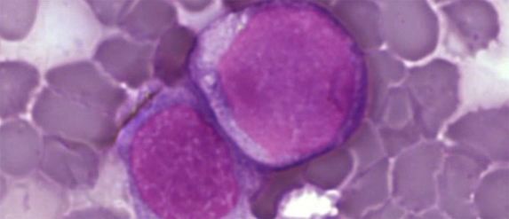 Leukemia cells dividing. Photo courtesy of Public Library of Science