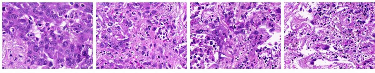 Lung Cancer Samples